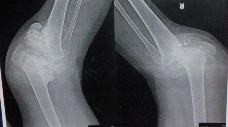 بين شبح البتر وأمل السفر. "دعاء" فتاة يفتت "شاركوت" عظامها (خاص)