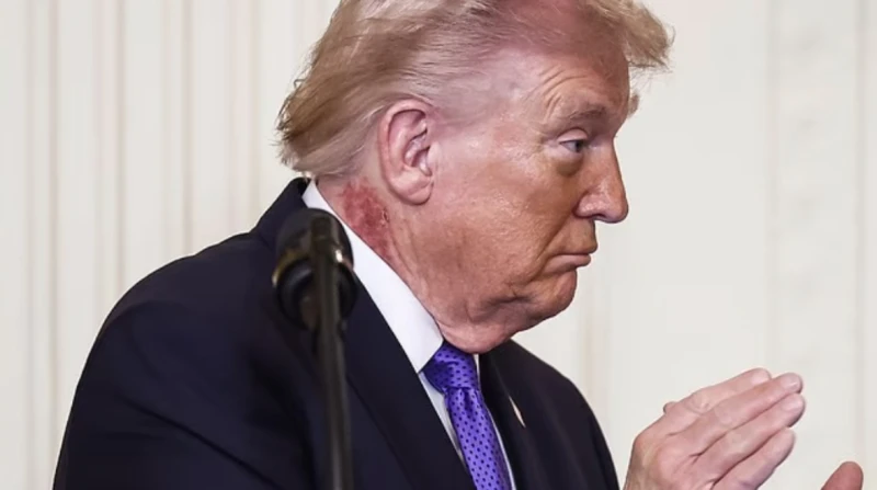 سر البقعة الحمراء في رقبة ترامب. جدري أم هربس أم سرطان