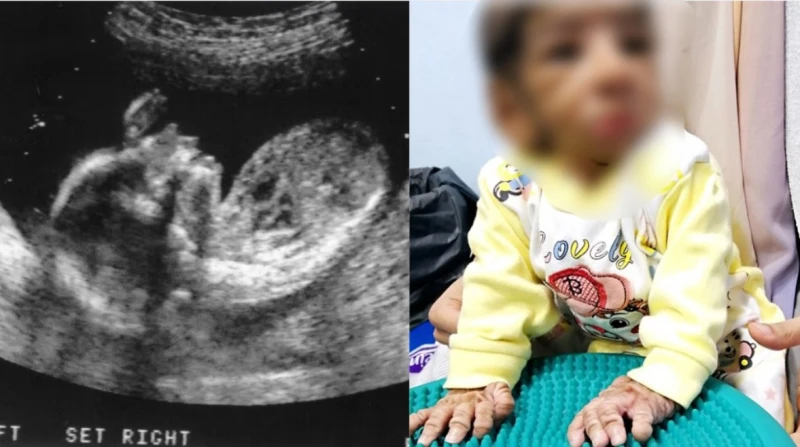 "من الشهر السابع وأنا عارفة إن في حاجة مش طبيعية". أم أنس تروي رحلة البحث عن تشخيص لابنها