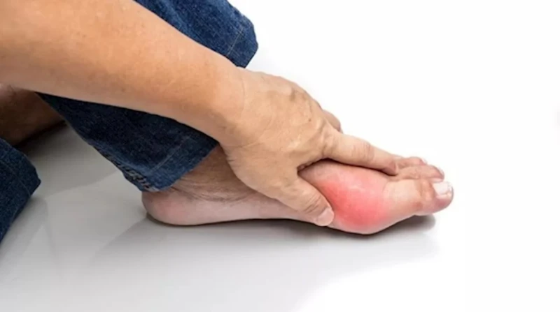 وداعاً لآلام المفاصل. 10 طرق منزلية فعالة لتخفيف أعراض النقرس