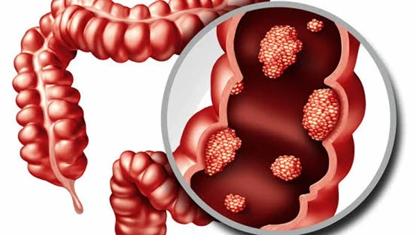 ١٠٠ مليون صحة.. أعراض الكشف المبكر عن سرطان القولون