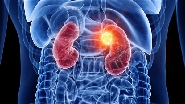 أسباب شائعة قد تؤدي للإصابة بالاعتلال الكلوي… احذر منها