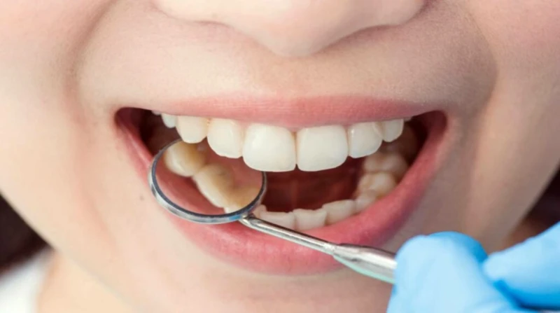 علاج تسوس الأسنان في 5 طرق. متى يجب زيارة الطبيب