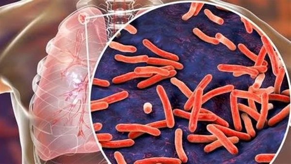 هل عاد الالتهاب السحائي لمصر؟