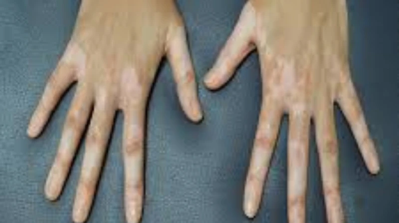 هل البهاق معدٍ؟ استشاري جلدية توضح الحقيقة كاملة