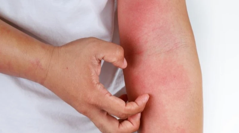 هل يؤثر التهاب الجلد على ذاكرتك؟. دراسة تكشف العلاقة بين الإكزيما وضعف الانتباه