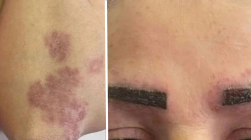 بسبب وشم الحواجب. سيدة تواجه مرضاً مناعياً غامضاً يربك الأطباء