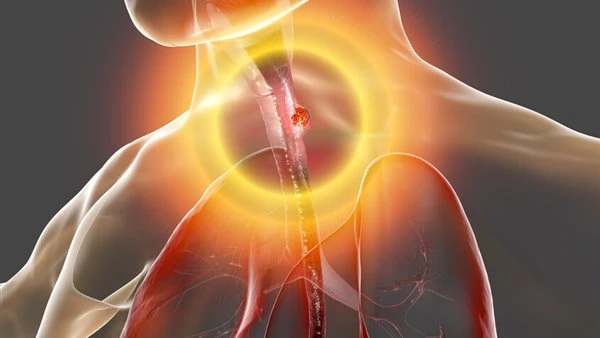 فك شفرة "القاتل الصامت".. دراسة تكشف مرحلة خفية تسبق سرطان المريء