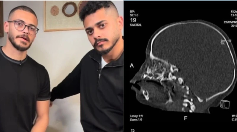 بعد فيديو "الزوزات" المؤثر. ما سبب حالة انعدام الأنف وكيفية العلاج