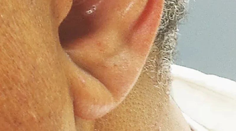 علامة فرانك.كيف ما العلاقة بين شكل شحمة الأذن واحتمال حدوث النوبات القلبية