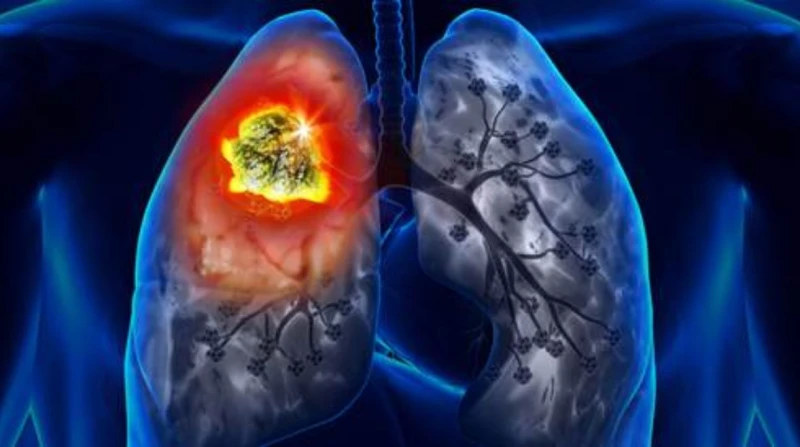 انتبه لأصابعك. علامة "صامتة" قد تكشف الإصابة بسرطان الرئة مبكرًا